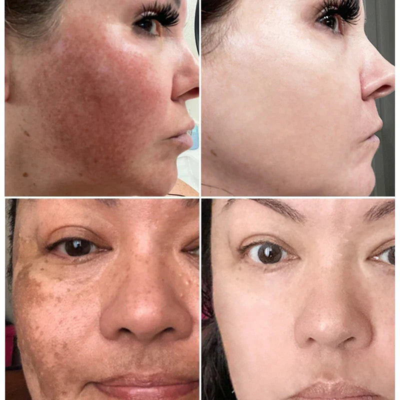 Whitening Freckles Cream - Korean Skincare