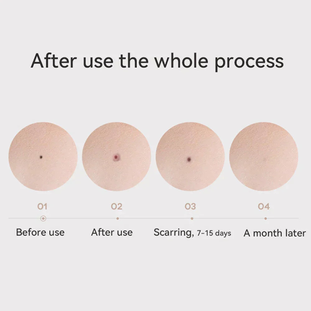 Clear Nevus Beauty Pen - Mole, Black Points, Wart, Spot, Tattoo Remover